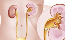 肾结石出现的六大原因 预防肾结石复发的饮食调理