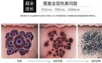 宁波薇琳整形医院祛斑怎么样？还您一张漂亮的容颜