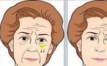 北京彤美整形医院刘风卓眼整形怎么样