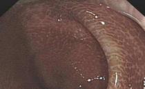 武汉汉西博仕肛肠医院：长期喝清肠茶 警惕结肠黑变病