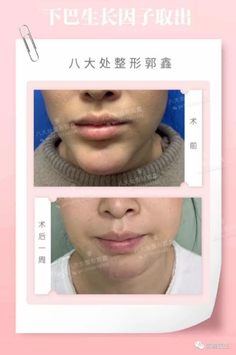 八大处整形郭鑫教授：下巴注射物取出需要多久