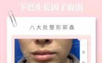 八大处整形郭鑫教授：下巴注射物取出需要多久