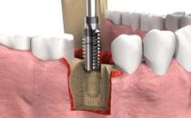 武汉做种植牙多少钱，种植牙品牌改如何选择？