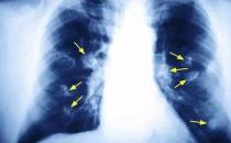 揪出引发女性肺癌的罪魁祸首 厨房油烟的危害超乎想象