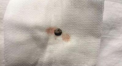 普瑞眼科取出患者眼内5毫米金属，保住眼球