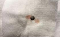 普瑞眼科取出患者眼内5毫米金属，保住眼球