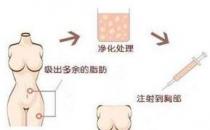 煤医整形：自体脂肪丰胸的四大优势