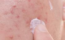 血热体质火气上升烦躁 调理血热多喝点菊花水