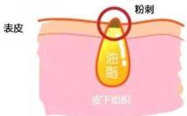 甲硝唑凝胶去黑头要看主流，别拿个体差异混淆视听