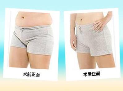 脂肪堆积怎么办 昆明韩辰360幸福吸脂 无需住院 苗条立现
