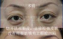 八大处整形郭鑫：上眼睑凹陷脂肪填充图片