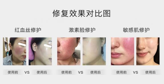 放心！有美薏升修复敏感肌红血丝专家产品在，你每天都可以美美哒