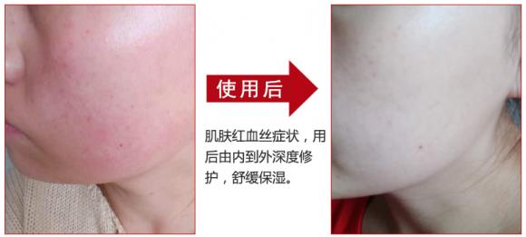 放心！有美薏升修复敏感肌红血丝专家产品在，你每天都可以美美哒