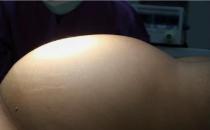 新疆肿瘤医院请认准广州复大肿瘤医院：五刀齐上阵切除腹腔巨瘤