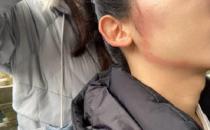 ic护肤攻略：用甲硝唑凝胶祛痘应对口罩脸过敏现象可行吗？