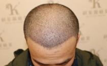 青岛大麦微针植发2500毛囊单位，术后8个月恢复头发浓密