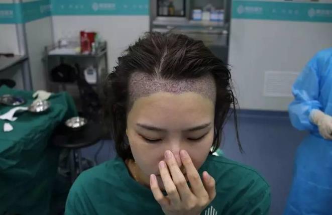 为什么植发效果相差半边天？广州青逸植发医院专家透入原因居然是……